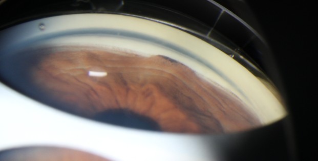 Webinar: Gonioscopie