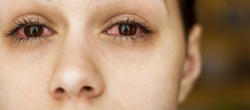 behalve voor Mart Gemaakt om te onthouden Rood oog | Optometristen Vereniging Nederland (OVN)
